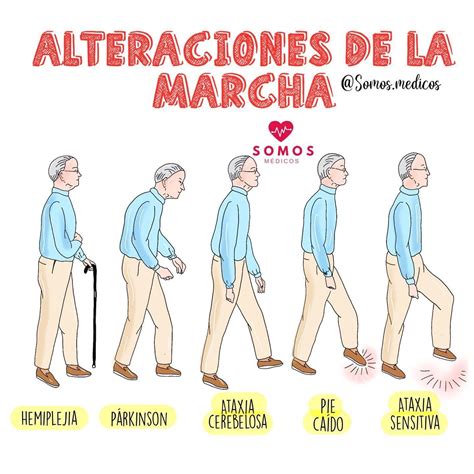 Infografía: Cambios normales en la marcha con la edad