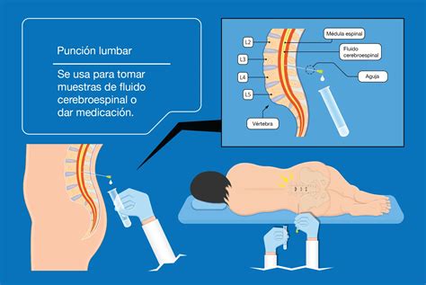 Diagrama de una punción lumbar y una representación de la electromiografía.