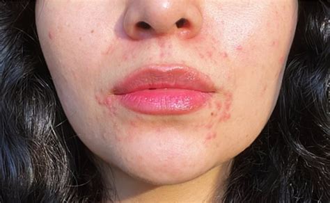 Foto de una persona con dermatitis perioral, mostrando las pápulas y eritema alrededor de la boca y nariz.