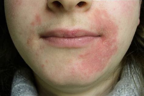 Esquema de las áreas faciales típicamente afectadas por la dermatitis perioral.