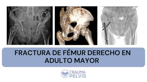 Esquema de las fracturas de fémur en personas mayores, mostrando los diferentes tipos de fractura de cadera (intracapsular y extracapsular)