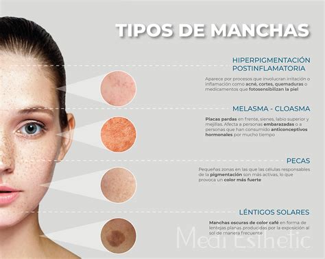 Infografía: Tipos de manchas rojas en la piel según su origen
