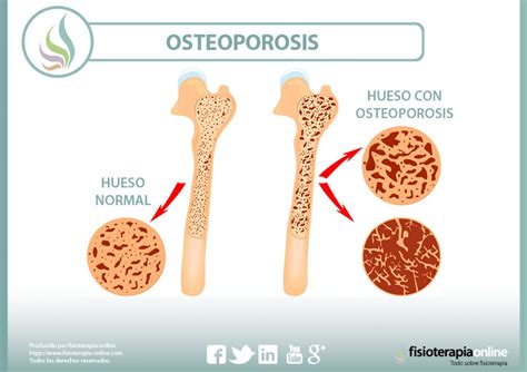 Esquema anatómico comparativo mostrando un hueso sano frente a un hueso con osteoporosis.