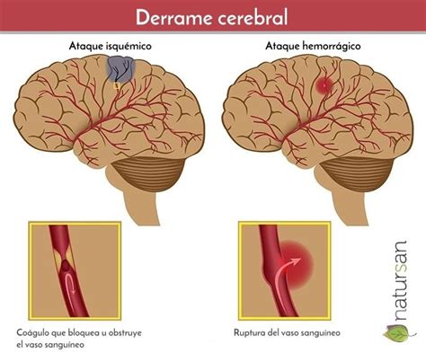 Esquema ilustrativo que compara un derrame cerebral isquémico (coágulo) frente a uno hemorrágico (rotura de vaso sanguíneo).