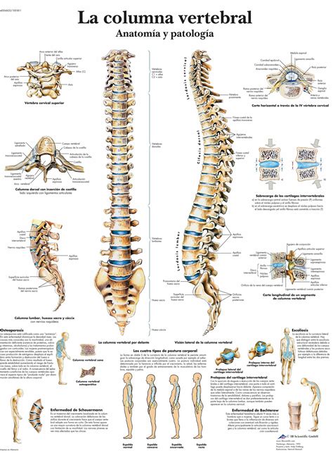 Esquema de las vértebras de la columna vertebral con un cuerpo vertebral colapsado debido a una fractura por compresión