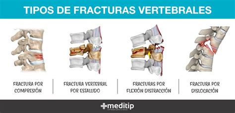 Infografía que muestra diferentes tipos de fracturas vertebrales por compresión (acuñamiento, bicóncava, colapso)