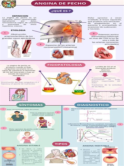 Infografía que muestra los diferentes tipos de angina de pecho y sus características distintivas.