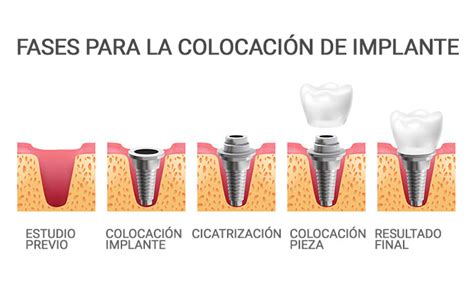 Infografía: Proceso de colocación de un implante dental con sus componentes