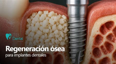 Diagrama ilustrativo de las diferentes técnicas de regeneración ósea dental