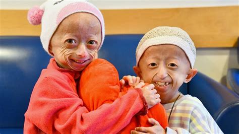 Bebé con síntomas de progeria, mostrando piel arrugada y rasgos faciales envejecidos.