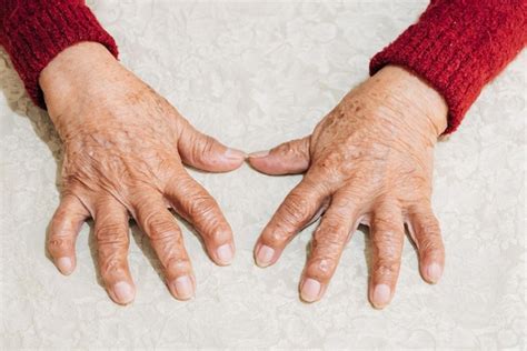 Foto de manos de adulto mayor con artritis realizando una tarea cotidiana