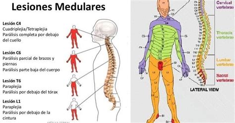 Representación visual de las diferentes áreas afectadas por lesiones medulares a nivel cervical, torácico y lumbar.