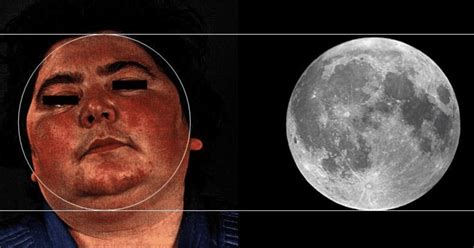 Ilustración mostrando los cambios faciales asociados al uso prolongado de corticoides (cara de luna llena).