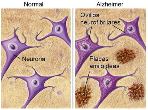Esquema de las placas amiloides y ovillos neurofibrilares en el cerebro afectado por Alzheimer