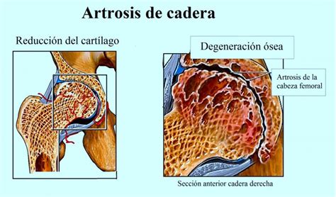 esquema de articulación de cadera sana y con artrosis