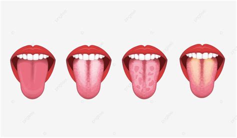 Ilustración de la lengua con una capa blanca visible