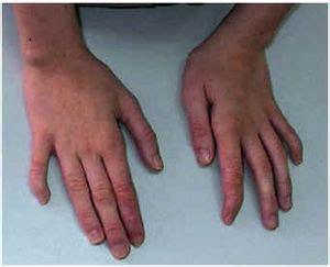 Foto: Hipoplasia de falanges del quinto dedo en paciente con fenotipo peculiar y retraso mental moderado