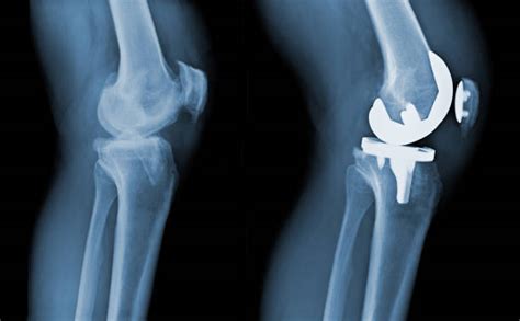 Radiografía de rodilla con prótesis total