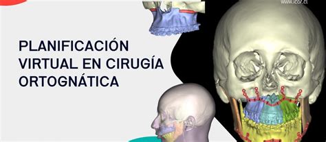 Infografía mostrando el proceso de planificación virtual 3D de una cirugía ortognática