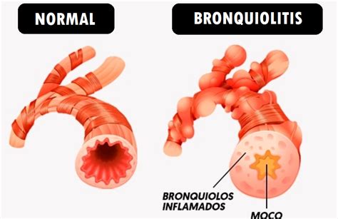 Esquema comparativo de bronquios sanos y bronquios inflamados con mucosidad