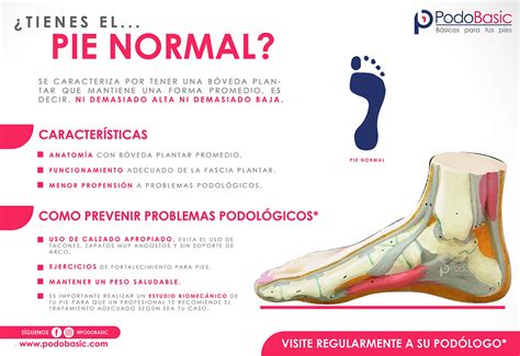 Esquema de un pie normal comparado con un pie bot (talipes equinovaro)