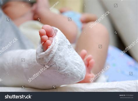 Fotografía de un bebé con yesos en ambos pies como parte del tratamiento del pie bot