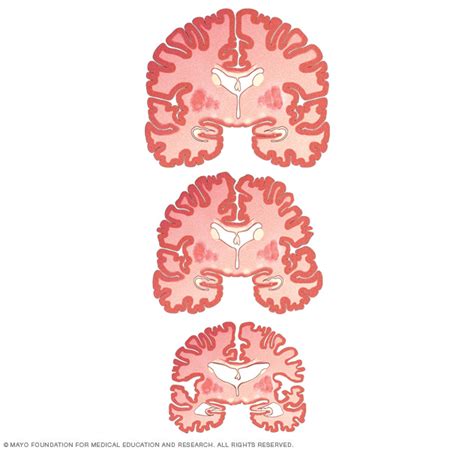 Infografía que ilustra la progresión del deterioro cognitivo en viudos frente a casados con presencia de amiloide cerebral.