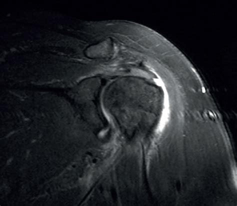 Radiografía o resonancia magnética de un hombro con tendinitis