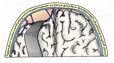 Esquema de las venas puente y el mecanismo del hematoma subdural