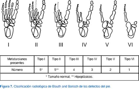 Esquema de una mano con ectrodactilia, mostrando la característica forma de pinza o hendidura, con ausencia de dedos centrales.