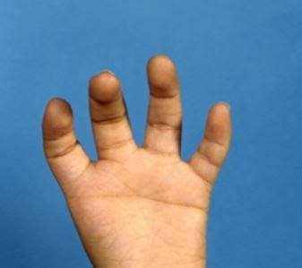Fotografía de una mano con simbraquidactilia, mostrando dedos cortos, algunos unidos por membranas y la posible ausencia de otros.