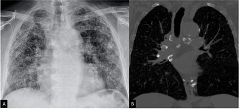 Radiografía de tórax mostrando nódulos pulmonares característicos de silicosis