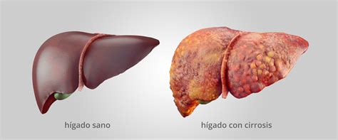 Esquema anatómico comparativo: Hígado sano frente a hígado con cirrosis y nódulos de regeneración.
