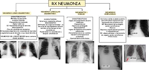 Esquema de los diferentes tipos de neumonía y las áreas pulmonares afectadas (unilateral, bilateral, bronconeumonía)