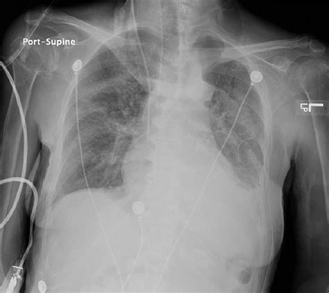Radiografía de tórax mostrando la correcta colocación de una sonda nasogástrica en el estómago