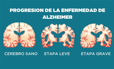 Ilustración esquemática de la progresión de la enfermedad de Alzheimer en el cerebro.