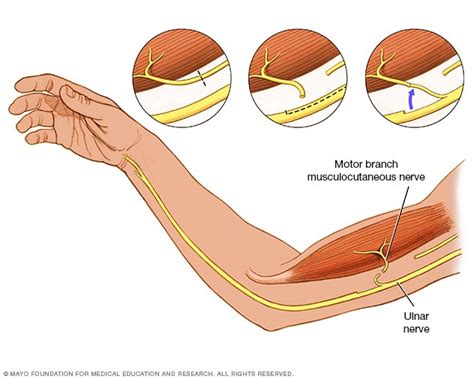 Esquema de un nervio sano vs. un nervio dañado por neuropatía diabética