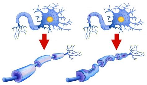 Esquema de una neurona con mielina dañada y placas de esclerosis múltiple