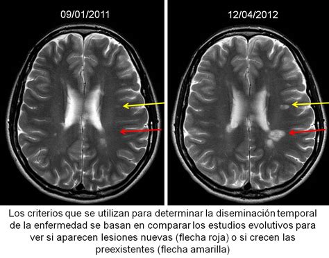 Imagen de resonancia magnética cerebral mostrando múltiples lesiones típicas de esclerosis múltiple