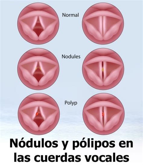 Ilustración de nódulos y pólipos en las cuerdas vocales.