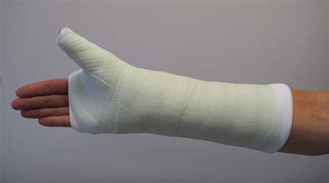 Ejemplo de yeso para fractura de escafoides