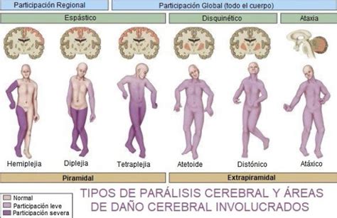 Diagrama de flujo mostrando los diferentes tipos de parálisis cerebral y sus características principales