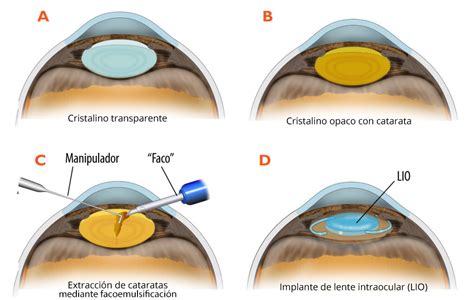 Esquema de un ojo con cristalino opaco (catarata) y cristalino transparente