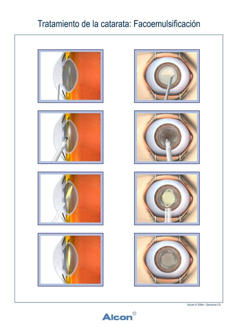 Infografía del proceso de facoemulsificación en la cirugía de cataratas