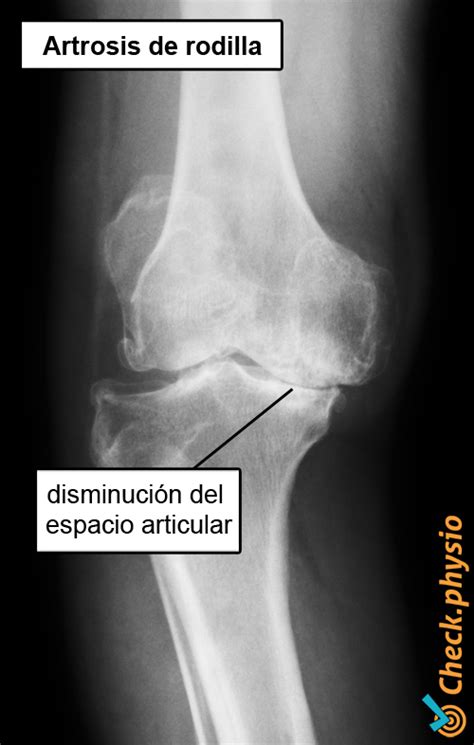 Radiografía de una articulación de rodilla con signos de desgaste (artrosis)