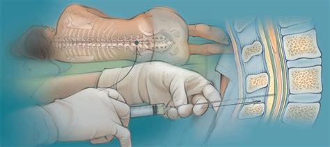 Esquema anatómico de la médula espinal y el sitio de punción lumbar entre las vértebras lumbares