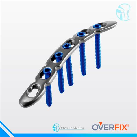 Esquema de placa con tornillos para fractura de clavícula