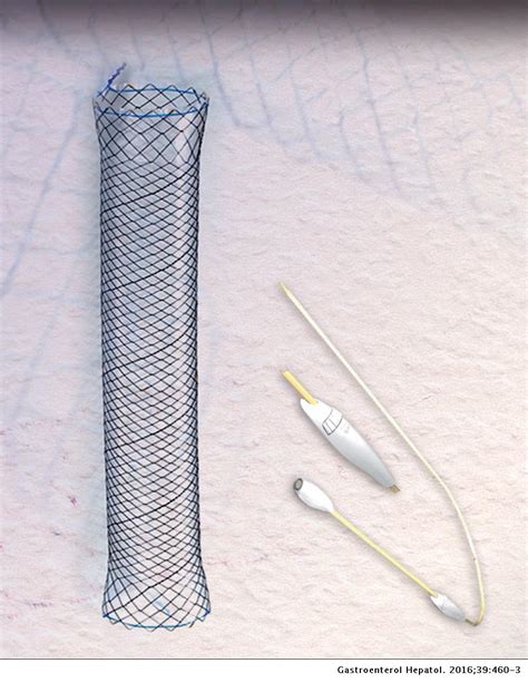 Ilustración detallada de una prótesis autoexpandible metálica (stent) y su mecanismo de liberación.