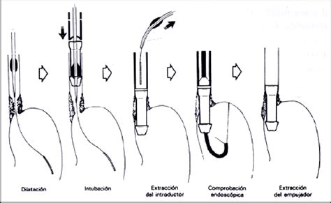 Diagrama que muestra la inserción de una prótesis autoexpandible a través de una estenosis tumoral en el esófago.