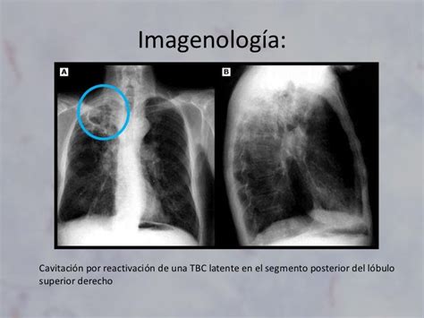 Radiografía de tórax con hallazgos típicos de tuberculosis pulmonar (cavitaciones en lóbulos superiores)